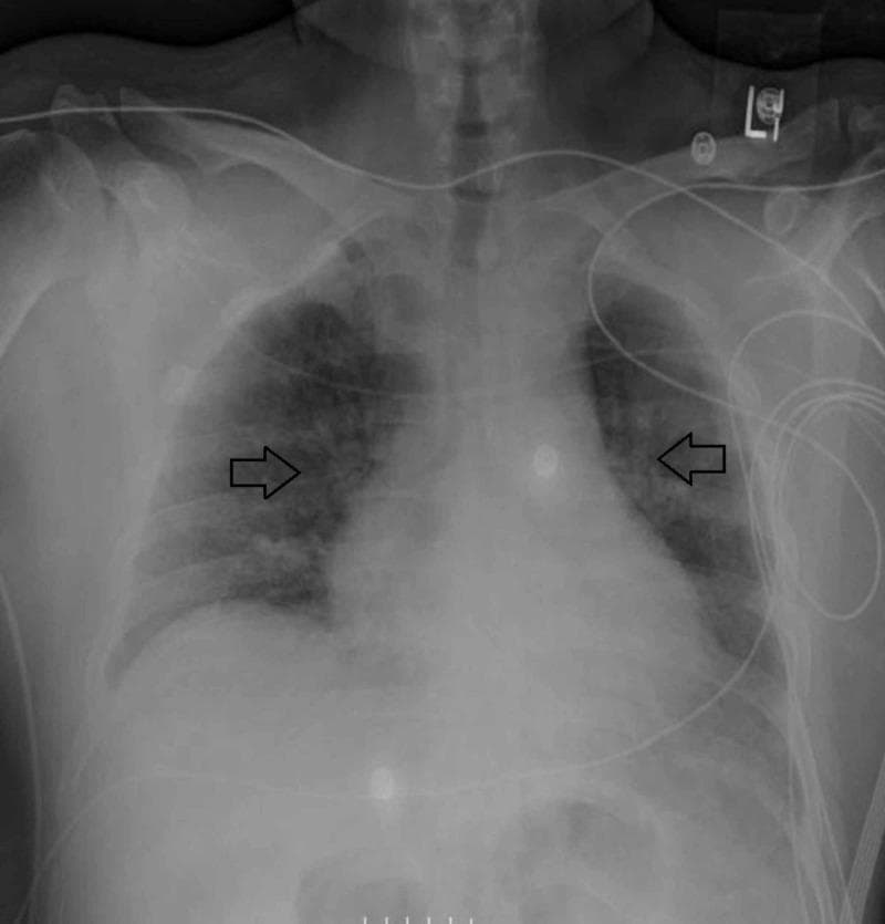 This diagnostic image is an anteroposterior (AP) chest X-ray demonstrating bilateral pulmonary infiltrates in a patient with respiratory failure. The lung fields show diffuse, patchy, and reticular opacities (indicated by horizontal black arrows) consistent with airspace disease and interstitial involvement. The infiltrates appear most prominent in the mid-to-lower lung zones, resulting in increased lung density and haziness that partially obscures normal bronchovascular markings. Several medical devices are visible, including multiple ECG leads and external monitoring tubing overlying the chest, consistent with a patient in an intensive care setting. The mediastinal silhouette and cardiac contours are present, though partially obscured by the adjacent pulmonary opacities. The skeletal structures, including the clavicles and ribs, appear intact. This radiograph serves as a clinical follow-up during intensive management (e.g., ECMO and corticosteroid therapy), illustrating the radiological presentation and interval assessment of diffuse alveolar damage or pulmonary vasculitis manifesting as Acute Respiratory Distress Syndrome (ARDS).