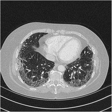 High-resolution computed tomography (HRCT) axial section of the chest demonstrating advanced interstitial lung disease. The image shows extensive reticular opacities with a predominant peripheral and subpleural distribution. There is evidence of architectural distortion characterized by early honeycombing, visible as small, clustered cystic spaces in the subpleural regions of both lower lobes. These findings are consistent with a Usual Interstitial Pneumonia (UIP) pattern, often associated with Idiopathic Pulmonary Fibrosis (IPF). The central lung parenchyma remains relatively spared compared to the dense fibrotic changes at the periphery. The imaging highlights the characteristic superior-to-inferior gradient of UIP, where fibrotic destruction is most pronounced in the lung bases. This diagnostic image serves as an educational tool for identifying the hallmarks of chronic fibrosing interstitial pneumonia, including subpleural reticulation, traction bronchiectasis, and honeycombing.