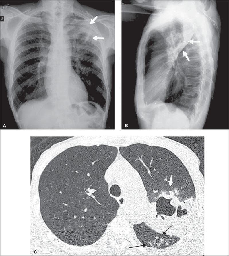 Diagnostic imaging composite of a 66-year-old male with active pulmonary tuberculosis (TB), comprising a posteroanterior chest X-ray (A), a lateral chest X-ray (B), and an axial High-Resolution Computed Tomography (HRCT) scan (C). Panels A and B demonstrate increased opacity in the left upper lung zone indicative of consolidation, with radiolucent areas representing cavitation (white arrows). Panel C, the HRCT at the level of the lower lobes, provides a detailed view of the pulmonary pathology. It reveals a focal area of dense consolidation containing a central air-filled cavity (white arrow) in the left lung. Additionally, characteristic 'tree-in-bud' patterns are visible (black arrows), consisting of small centrilobular nodules and branching linear opacities that indicate endobronchial spread of infection within the upper segment of the left lower lobe. These imaging findings are hallmark radiological features of secondary or active tuberculosis, illustrating parenchymal destruction and small airway involvement.