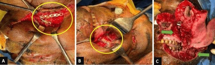 This composite of three intraoperative clinical photographs demonstrates the surgical management of complex maxillofacial trauma, specifically focusing on the open reduction and internal fixation (ORIF) of a left zygomaticomaxillary complex (ZMC) fracture. Panel A shows a subtarsal approach with surgical retractors exposing the left infraorbital margin, where a multi-hole metallic titanium plate and screws have been applied to stabilize the fracture line. Panel B displays the intraoral exposure of the left zygomatic buttress, showing a four-hole L-shaped plate secured with osteosynthesis screws for structural stability. Panel C illustrates the facial soft tissue injury and subsequent management, showing extensive lacerations involving the left cheek and upper lip region (highlighted by green arrows) during the debridement and layered closure phase. The images provide a detailed view of surgical landmarks, hardware placement, and soft tissue reconstruction essential for oral and maxillofacial surgery education. Key concepts include ZMC fracture stabilization, surgical access via subtarsal and vestibular incisions, and the use of internal fixation systems.