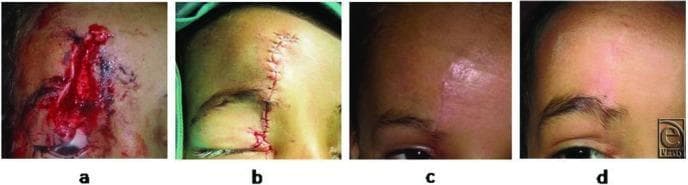 This clinical progression series comprises four photographs documenting the repair and healing of a traumatic facial laceration. Panel (a) shows the initial injury: a vertical, deep 6-cm laceration on the forehead involving the skin, subcutaneous fat, and muscle, characterized by tissue gaping and fresh blood. Panel (b) depicts the wound immediately postoperative after primary closure using autologous hair filament sutures; the edges are well-approximated with visible interrupted stitches and minimal peri-wound erythema. Panel (c) shows the follow-up at 5 weeks, demonstrating a maturing, slightly erythematous linear scar without suture track marks or infection. Panel (d) illustrates the 6-month long-term outcome, displaying a soft, flat, hypopigmented scar that blends with the surrounding skin texture. The series highlights surgical techniques aimed at minimizing permanent scarring and suture-induced ‘railroad’ marks in pediatric plastic surgery and emergency medicine contexts.
