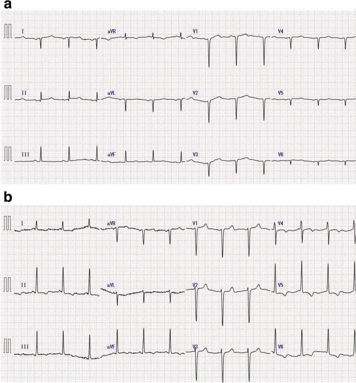 This diagnostic image consists of two 12-lead electrocardiograms (ECG) labeled (a) and (b), illustrating the electrical manifestations of situs inversus totalis and comorbid coronary artery disease. Panel (a) shows an ECG with standard lead placement, demonstrating a negative P-wave in leads I and aVL and a positive P-wave in lead aVR, characteristic of dextrocardia. Panel (b) shows the ECG after correcting for situs inversus by reversing the right and left limb leads and placing chest leads in a mirror-image configuration on the right side of the thorax. This corrected view reveals underlying ischemic changes, specifically ST-segment depression in the lateral leads (I, aVL, V5, V6) and T-wave inversions in the inferior (II, III, aVF) and precordial (V4-V6) leads. These visual findings provide a clinical comparison between the baseline electrical axis abnormalities seen in situs inversus and the subsequent diagnosis of multi-vessel coronary artery disease through modified lead positioning.