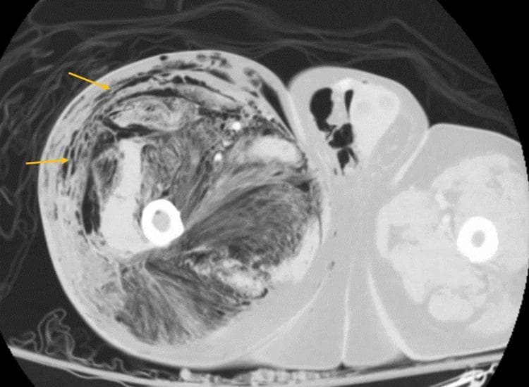 This diagnostic image is an axial non-contrast CT scan of the lower extremities, specifically focusing on the thigh region. The right thigh (left side of the image) demonstrates a massive, diffuse collection of subcutaneous and deep soft tissue gas, indicated by low-density (black) areas. Yellow arrows highlight gas tracking extensively along the fascial planes, within the subcutaneous fat, and dissecting between muscle compartments. There is significant soft tissue edema and architectural distortion, with a loss of normal fat planes and muscle definition compared to the relatively normal-appearing contralateral limb. Key findings include 'gas in soft tissues' or 'emphysematous changes,' which are pathognomonic for necrotizing fasciitis or clostridial myonecrosis (gas gangrene) in a clinical context of sepsis. Additionally, gas is visible within the scrotal region, suggesting proximal or distal extension of the necrotizing process. This image serves as a critical educational example of surgical emergency findings in musculoskeletal radiology and infectious disease.