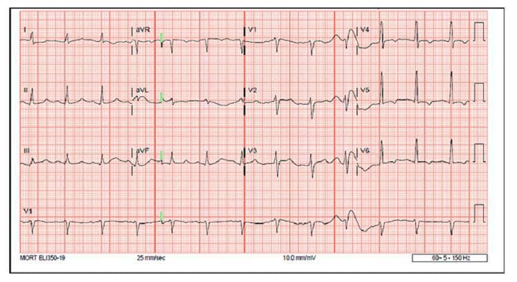 A 12-lead electrocardiogram (EKG) tracing displaying diagnostic findings associated with true hyperkalemia (7.4 mmol/L) in the context of acute kidney injury and metabolic acidosis. The tracing exhibits several critical electrolyte-induced abnormalities. Notable findings include a significantly prolonged QTc interval, measured at 522 ms (normal <440 ms), most visible in leads II, III, V5, and V6. Additionally, there are distinct T-wave inversions in the lateral leads, specifically I, aVL, V4, V5, and V6. The EKG serves as an educational illustration of how severe hyperkalemia can paradoxically manifest with QTc prolongation and lateral T-wave inversion rather than the classic 'peaked' T-wave morphology. This tracing is relevant for emergency medicine and nephrology, emphasizing the importance of recognizing atypical cardiac electrical manifestations of electrolyte imbalances to guide urgent clinical intervention.