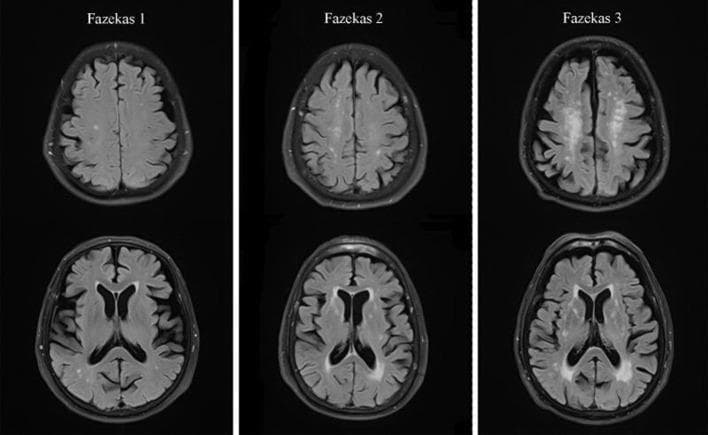 This diagnostic image consists of axial T2-weighted Fluid-Attenuated Inversion Recovery (FLAIR) MRI scans of the human brain, illustrating the Fazekas scale for grading white matter hyperintensities (WMH). The image is organized into three columns representing Fazekas grades 1, 2, and 3. Grade 1 (left) shows mild punctiform lesions in the deep subcortical white matter (DSWMH) and thin, cap-like or pencil-thin hyperintensities along the periventricular white matter (PVWMH). Grade 2 (middle) demonstrates moderate progression, characterized by the initial fusion of subcortical lesions and a smooth, halo-like thickening around the lateral ventricles. Grade 3 (right) represents severe disease, showing massive confluence of hyperintense lesions in the deep white matter and irregular periventricular signals that extend deeply into the brain parenchyma. This comparison chart is essential for clinical neurology and radiology to assess small vessel disease, leukoaraiosis, and age-related cognitive decline markers.