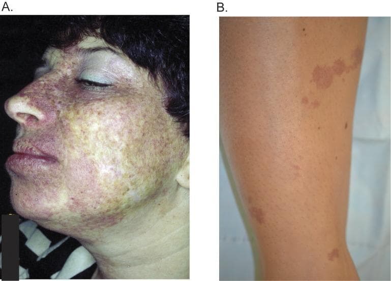 This clinical photograph comparison displays two presentations of port-wine stains (PWS), or nevus flammeus, which are congenital capillary malformations. Image A shows a diffuse facial PWS on a female patient, primarily involving the left maxillary (V2) and mandibular (V3) dermatomes of the trigeminal nerve. The lesion presents as a confluent, mottled area of pink, red, and dusky purple discoloration extending across the cheek, chin, upper lip, and nose. Image B shows a more localized PWS on the shin of a different individual. This presentation consists of discrete, irregularly shaped, light-red to purple-tan patches arranged in a linear distribution against unaffected skin. These images illustrate the phenotypic variability of PWS in different anatomical locations and their potential association with somatic mutations, such as GNAQ variants. The educational focus is on clinical morphology, dermatomal distribution, and the distinction between confluent facial lesions and localized extremity lesions in pediatric and adult dermatology.