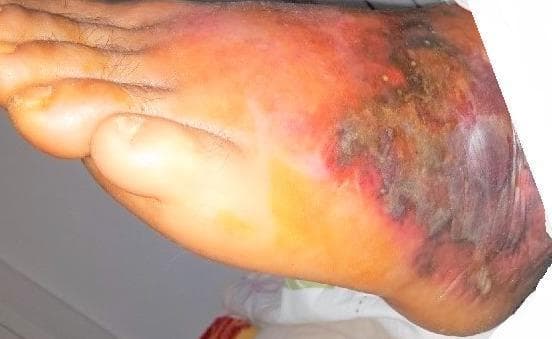 A clinical photograph of the dorsal and lateral aspect of a human foot demonstrating clinical signs of necrotizing fasciitis. The image shows a progressive cutaneous infection characterized by widespread, poorly demarcated erythema extending from the toes towards the midfoot and ankle. Central to the lesion, there is significant skin discoloration with shades of violaceous, dusky purple, and black, indicating deep tissue ischemia and evolving necrosis. The affected area exhibits visible swelling (edema) and irregular skin texture, including possible hemorrhagic bullae or desquamation. The visual findings represent a surgical emergency, illustrating the rapid progression from superficial inflammation to full-thickness soft tissue destruction. This content is intended for medical education regarding the identification of life-threatening soft tissue infections and distinguishing them from uncomplicated cellulitis.