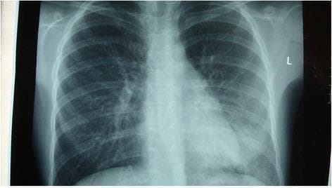 A posterior-anterior (PA) chest x-ray demonstrating localized pathology in the right lung. There is a notable area of increased opacity and consolidation in the right lower lobe, which partially obscures the right hemidiaphragm and suggests an infectious process such as pneumonia. In contrast, the left lung field appears relatively clear and well-aerated with normal vascular markings. The cardiac silhouette, mediastinal contours, and trachea appear within normal limits. The skeletal structures of the ribcage and clavicles are intact and clearly visible. This diagnostic image illustrates the typical radiographic presentation of community-acquired pneumonia, characterized by alveolar infiltration and consolidation in a specific anatomical lobe, used clinically to guide antibiotic treatment and monitor disease progression.