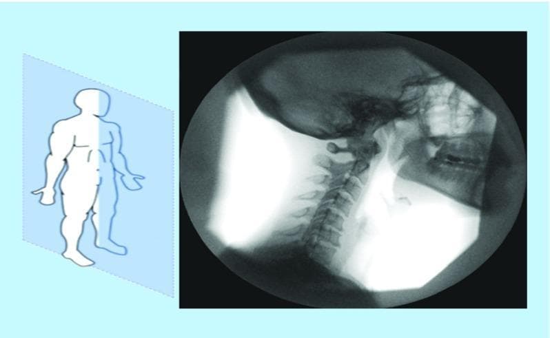 This medical visual consists of two parts: a reference anatomical diagram and a diagnostic image. On the left, a schematic illustration of a human body shows a highlighted sagittal plane to establish anatomical orientation. On the right, a fluoroscopic X-ray image of the head and neck is presented in the sagittal view. The imaging modality is characterized by its circular field of view and dynamic grayscale contrast, typical of real-time fluoroscopy. Anatomically, the image clearly depicts the base of the skull, the facial bones including the maxilla and mandible, and the cervical spine (C1-C7). The articulated vertebrae are visible as radiopaque (lighter) structures against the darker, radiolucent air and soft tissues of the oropharynx and neck. Key landmarks include the spinous processes of the cervical vertebrae and the jawline. This visual is designed for educational use in teaching radiographic anatomy, specifically focusing on spinal alignment, posture, and the structural relationships within the head and neck region during clinical evaluation.