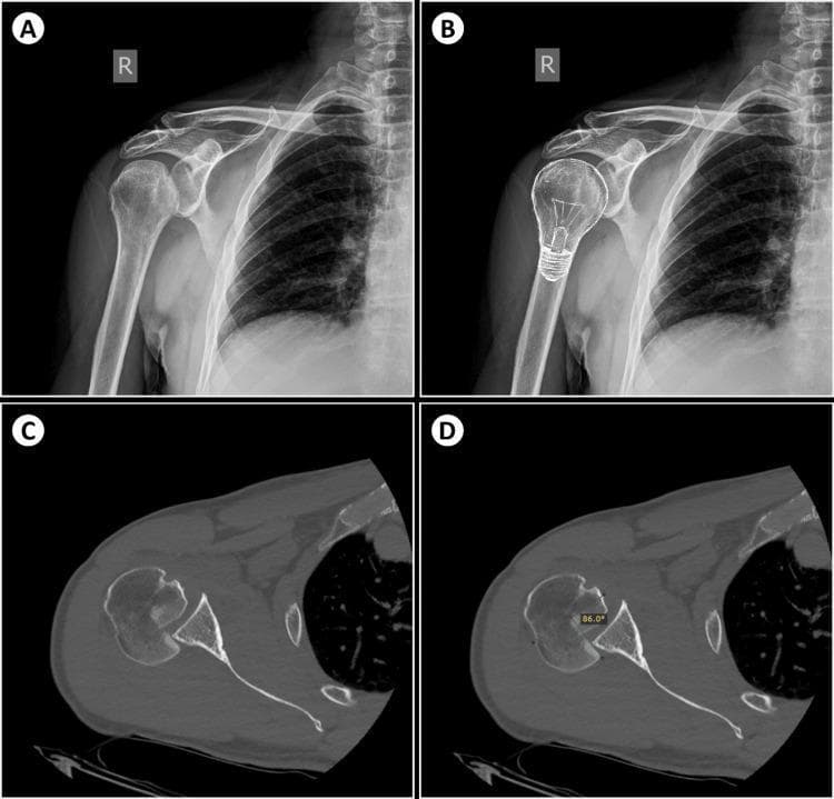 This composite diagnostic image illustrates the radiologic signs of a posterior shoulder dislocation and an associated reverse Hill-Sachs lesion in the right shoulder. Panels A and B present an anteroposterior (AP) X-ray. Panel A shows the 'light-bulb sign,' where internal rotation of the humerus causes the humeral head to appear symmetric and rounded, resembling a light bulb. Panel B includes a graphic overlay of a light bulb to highlight this configuration. Panels C and D provide axial CT scan slices of the same joint. Panel C confirms the posterior displacement of the humeral head relative to the glenoid fossa and reveals a synchronous reverse Hill-Sachs lesion, characterized by an impaction fracture on the anteromedial aspect of the humeral head. Panel D demonstrates a quantitative assessment of the defect using the Cicak method, showing a large impaction fracture involving approximately 50% of the articular surface with an angular measurement of 86.0 degrees. This visual set is an educational resource for identifying subtle radiographic indicators of posterior shoulder instability and associated bony defects.
