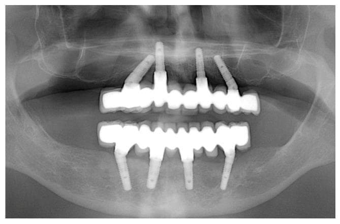 This orthopantomograph (OPG) displays a full-arch dental rehabilitation of both the maxilla and mandible using the All-on-4 treatment concept. In the maxillary arch, four endosseous implants support a fixed radiopaque prosthesis; the two anterior implants are placed vertically, while the two posterior implants are distally tilted to bypass the maxillary sinuses and maximize the prosthetic base. The mandibular arch similarly shows four implants supporting a full-arch prosthesis, with tilted posterior fixtures positioned anterior to the mental foramina. The bone-to-implant interface demonstrates stable peri-implant marginal bone levels at this five-year follow-up, with no significant peri-implant radiolucencies. Key anatomical structures visible include the maxillary sinuses, the nasal cavity floor, and the inferior alveolar nerve canals. This diagnostic image illustrates long-term successful osseointegration and the geometric distribution of implants required for fixed edentulous restoration in oral and maxillofacial surgery.