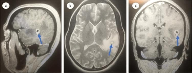 This diagnostic imaging composite displays Magnetic Resonance Imaging (MRI) of the brain in three planes: sagittal (a), axial (b), and coronal (c). The images reveal a single, well-defined, rounded ring-enhancing lesion located in the left parietal region. In the T2-weighted axial view (b), the lesion is hyperintense with a hypointense rim and is surrounded by extensive hyperintense signal indicating vasogenic edema, which results in partial effacement of the adjacent cortical sulci and subarachnoid space. Contrast-enhanced sections (a and c) demonstrate moderate, discrete peripheral rim enhancement with a darker central core. Blue arrows in each panel point to the lesion and its associated inflammatory changes. This presentation is characteristic of a neuroinflammatory process or an infectious granuloma, such as neurocysticercosis or a cerebral abscess. The imaging is critical for medical students and clinicians to study intracranial mass effects, the breakdown of the blood-brain barrier, and differential diagnosis of ring-enhancing lesions.