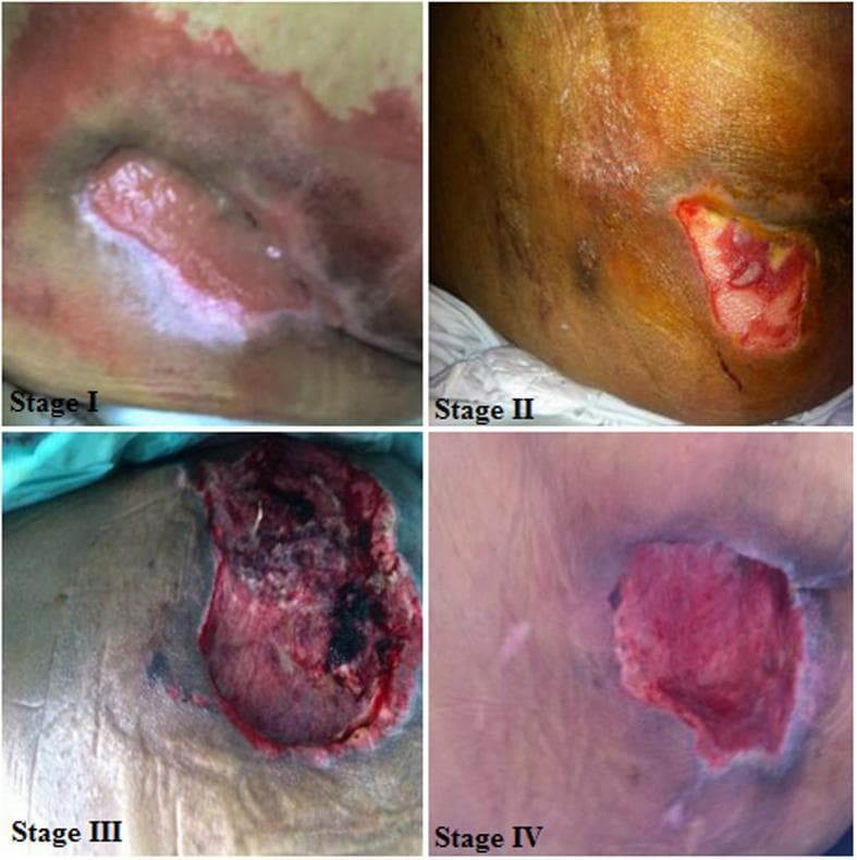 A multi-panel clinical photograph illustrating the four-stage classification of pressure ulcers (decubitus ulcers) in human skin. Panel 'Stage I' depicts intact skin with localized non-blanchable erythema and significant surrounding discoloration. Panel 'Stage II' shows a partial-thickness skin loss involving the epidermis and dermis, presenting as a shallow open ulcer with a red-pink wound bed and visible slough. Panel 'Stage III' demonstrates full-thickness tissue loss with visible subcutaneous involvement; the wound is deeper with evidence of necrotic tissue and dark eschar. Panel 'Stage IV' illustrates advanced full-thickness tissue loss with extensive destruction, revealing deep structures such as muscle or fascia, and potentially exposing bone or tendon. This educational resource is used in dermatology and nursing education to differentiate wound severity and guide staging based on tissue depth, color morphology, and integrity of anatomical layers.
