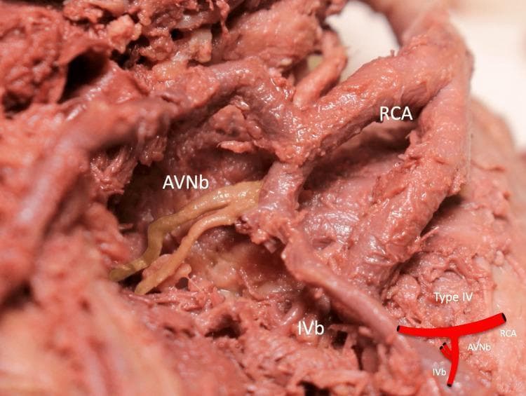 This clinical photograph of a formalin-fixed human heart specimen demonstrates a Type IV anatomical variation of the coronary arterial supply. The image focuses on the inferior pyramidal space, showing the Right Coronary Artery (RCA) and its distal branches. Key anatomical structures labeled include the RCA, the Inferior Interventricular Branch (IVb), and a duplicated Atrioventricular Nodal Branch (AVNb). The AVNb exhibits a distinct pale, yellowish-beige color and smooth texture compared to the deeper reddish-brown, striated appearance of the RCA and IVb. The duplicated AVNb originates from the RCA in close proximity to the origin of the IVb, illustrating a specific branching pattern relevant to cardiac electrophysiology and surgical anatomy. A schematic diagram in the lower right corner provides a simplified representation of the Type IV branching configuration. The specimen highlights developmental arterial variations that are clinically significant for procedures involving the AV node or during coronary revascularization.