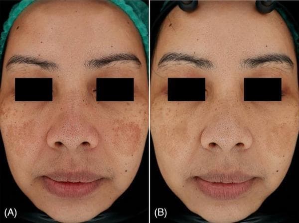 This clinical photograph comparison shows the face of a 39-year-old female patient diagnosed with facial melasma, highlighting a before-and-after treatment progression over three months. Image (A) displays baseline hyperpigmentation characterized by confluent, brownish patches with irregular borders, symmetrically distributed across the malar regions (cheeks) and the nasal bridge. The pigmentation appears dense with a mottled texture. Image (B), taken three months after laser therapy, demonstrates a significant clinical improvement. There is a visible reduction in the size, color intensity, and overall density of the melasma patches. The skin tone appears more uniform and brightened, with less prominent follicular or pore visibility in the affected areas. This comparison illustrates the effectiveness of dermatological laser intervention for managing epidermal and dermal hyperpigmentation disorders in adult patients.