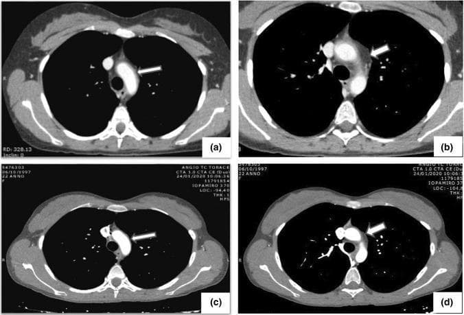 This set of four axial Computed Tomography Angiography (CTA) scans demonstrates the thoracic aorta in a patient with Takayasu arteritis, highlighting the diagnostic features of large-vessel vasculitis. Panels (a) and (b) show the pre-treatment phase, characterized by significant circumferential wall thickening of the aortic arch (arrows) with associated mural contrast enhancement. This 'halo' or 'macaroni' sign indicates active vessel wall inflammation. Panels (c) and (d) present follow-up imaging of the same anatomical regions after medical intervention. These post-treatment scans show a marked reduction in both mural thickness and contrast enhancement, signifying a positive therapeutic response and decreased disease activity. The imaging modality utilizes intravenous iodinated contrast to differentiate between the arterial lumen and the pathological vessel wall. This comparison is clinically significant for monitoring disease progression and the efficacy of immunosuppressive therapy in vasculitis patients.