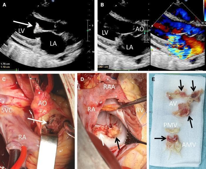 This composite figure presents clinical imaging and surgical findings of infective endocarditis. (A) Transthoracic echocardiogram (TTE) in a long-axis view shows a large, pedunculated echogenic vegetation (white arrow) measuring 1.75 cm x 1.10 cm attached to the anterior mitral valve leaflet. (B) TTE with color Doppler demonstrates a mosaic-pattern jet across the mitral valve, indicating severe mitral regurgitation. (C) Intraoperative view through the aorta (AO) reveals a yellowish vegetation (white arrow) infiltrating the aortic valve cusp. (D) Surgical exposure of the mitral valve via the right atrium (RA) shows extensive friable, yellowish vegetations (arrows) involving the anterior mitral cusp and annulus. (E) Gross specimen photograph displays the excised material on surgical gauze, with arrows pointing to the vegetations associated with the aortic valve (AV) and anterior mitral valve (AMV) tissue. The images collectively demonstrate the progression from diagnostic ultrasonography to surgical management of multi-valvular endocarditis, highlighting the morphology and destructive nature of infective vegetations.