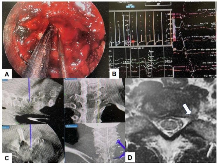 A multi-panel medical illustration showcasing a cervical endoscopic keyhole foraminotomy procedure. Panel (A) provides an intraoperative endoscopic view showing surgical instruments, including a dissector and a suction-irrigation cannula, positioned within the operative field against paraspinal muscle and soft tissue. Panel (B) demonstrates real-time intraoperative neurophysiological monitoring (IONM) waveforms used to ensure nerve root integrity. Panel (C) displays a surgical navigation monitor showing multi-planar fluoroscopic or CT-based reconstructions of the cervical spine with a blue virtual probe indicating the surgical trajectory. Panel (D) is an axial T2-weighted MRI image of the cervical spine, where a white arrow highlights a paracentral disc herniation impinging on the neural foramen and spinal cord. This composite image illustrates the integration of minimally invasive endoscopic techniques, navigation, and neuromonitoring for treating cervical radiculopathy and disc herniation.