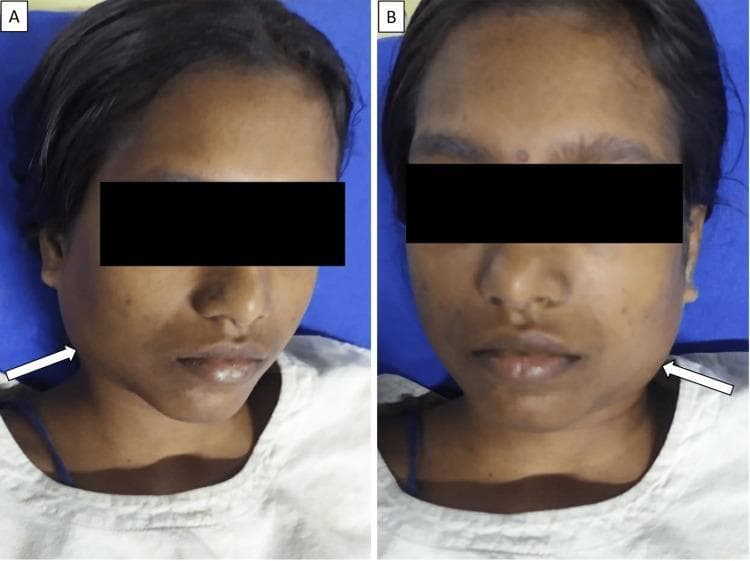 Two clinical photographs (A and B) showing the frontal and slightly oblique facial views of a patient presenting with bilateral parotid swelling. White arrows in each panel highlight large, diffuse, non-erythematous swellings in the preauricular and infraauricular regions, extending down toward the angle of the mandible. The swellings are symmetrical and characteristic of acute parotitis. The patient also exhibits generalized facial puffiness and mild conjunctival congestion. The eyes are obscured by black privacy bars. This clinical presentation is typical of viral parotitis, such as that caused by the mumps virus, which can be associated with systemic complications including myocarditis and pleural effusion in severe cases. The skin tone is consistent with a South Asian phenotype, showing minor post-inflammatory hyperpigmentation spots but no overt primary cutaneous lesions.