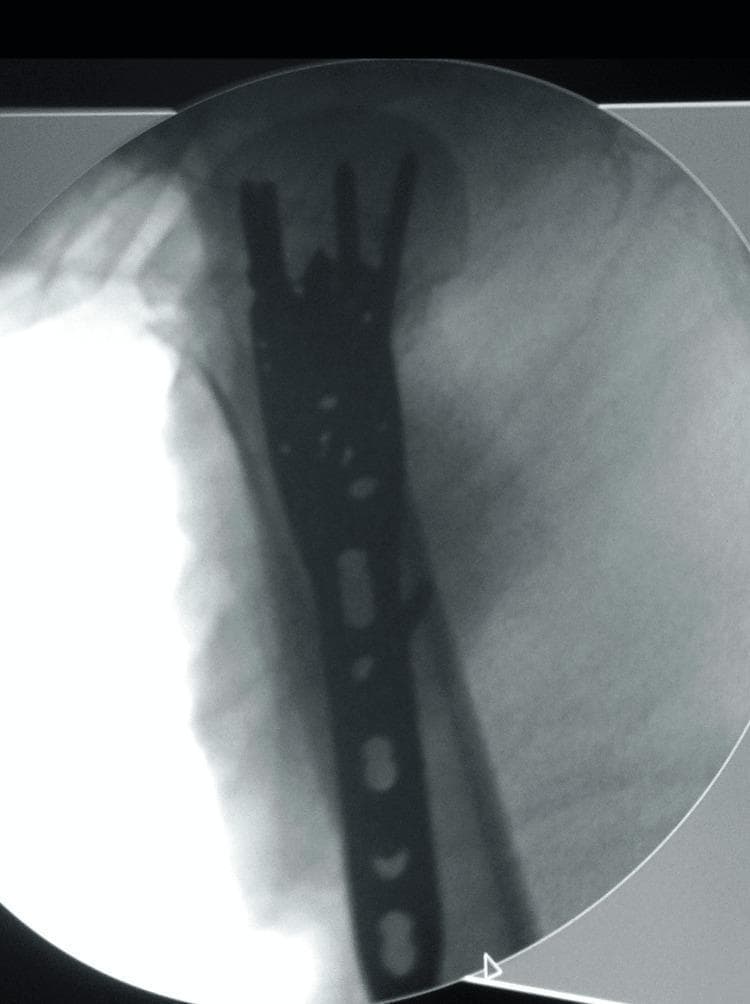 This intra-operative radiograph (fluoroscopy) demonstrates the surgical fixation of a proximal humeral fracture using a PHILOS (Proximal Humeral Interlocking System) plate. The image shows the radiopaque metallic plate positioned along the lateral aspect of the proximal humerus. The proximal portion of the plate is wider and contoured to fit the greater tuberosity, featuring multiple screw holes directed into the humeral head to provide multidirectional stability. Several locking screws are visible, penetrating the humeral head to secure fracture fragments. The distal shaft of the plate is narrower, following the humeral diaphysis, and contains several longitudinal slotted holes (combislots) for both compression and locking screws. The plate-bone interface shows close apposition, indicating proper reduction and hardware placement. This visual is typical of orthopedic trauma surgery, specifically for treating displaced proximal humerus fractures, aiming to preserve the vascularity of the humeral head while providing stable internal fixation for early mobilization.