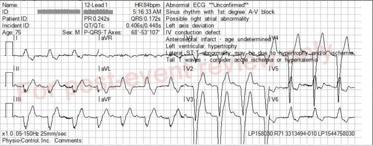 This diagnostic image is a 12-lead electrocardiogram (ECG) demonstrating multiple conduction and metabolic abnormalities. The tracing shows a sinus rhythm with a prolonged PR interval (0.242s), indicating first-degree atrioventricular (AV) block. The QRS complex is significantly widened (0.172s) with a morphology consistent with a left bundle branch block (LBBB) pattern, characterized by deep S waves in V1-V3 and broad, notched R waves in lateral leads such as V6 and aVL. Notably, the T waves are disproportionately tall, peaked, and 'tented,' particularly visible in the precordial leads V2-V5. These peaked T waves, when combined with QRS widening, are classic electrocardiographic manifestations of hyperkalemia. The image also displays left axis deviation and secondary ST-T wave discordance typical of LBBB. This ECG serves as a critical educational example of how metabolic disturbances like hyperkalemia can overlay and exacerbate underlying conduction system disease in a clinical emergency setting.