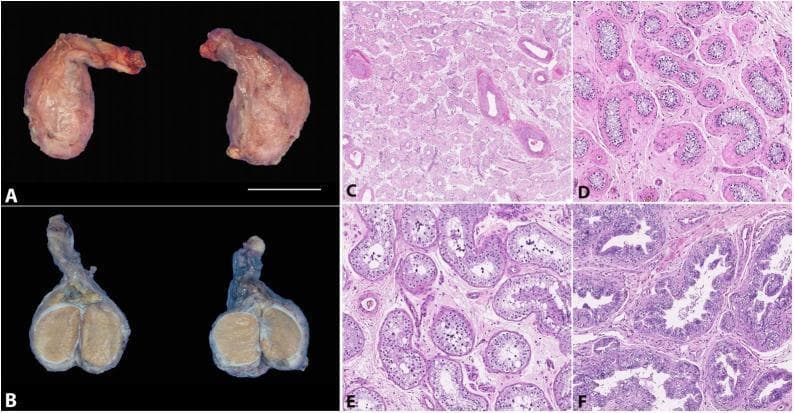This composite figure illustrates the gross and microscopic pathology of an orchiectomy specimen following hormone therapy. Panels A and B show the gross external and cut surfaces of the testis and epididymis; the external surface is pale pink-tan and smooth, while the cut surface reveals a homogenous, tan parenchyma (scale bar = 3 cm). Panels C through F are light micrographs stained with Hematoxylin and Eosin (H&E) demonstrating characteristic histopathological changes. Panel C (40X) displays widespread fibrosis of seminiferous tubules and a notable absence of Leydig cells. Panel D (100X) highlights prominent peritubular hyalinization and fibrosis. Panel E (100X) illustrates significantly reduced spermatogenesis and germ cell maturation arrest within the tubules. Panel F (100X) shows peri-epididymal fibrosis accompanied by hyperplasia of the epididymal epithelium. This collection serves as an educational reference for the effects of gender-affirming hormone therapy on testicular architecture and spermatogenesis.
