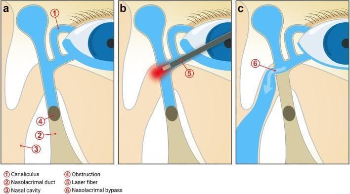 This three-panel medical schematic (Pathophysiology Diagram and Surgical Algorithm) illustrates the mechanism and surgical correction of primary acquired nasolacrimal duct obstruction (PANDO) via laser-assisted dacryocystorhinostomy (DCR). Panel A depicts the pre-operative state where an infrasaccal obstruction (4) in the nasolacrimal duct (2) blocks tear drainage, despite patent canaliculi (1), leading to epiphora. Panel B shows the intra-operative procedure, where a transcanalicular laser fiber (5) is advanced into the lacrimal sac and directed medially toward the nasal wall to create a bypass. Panel C illustrates the post-operative outcome: a newly formed nasolacrimal bypass or ostium (6) allows tears to drain directly from the lacrimal sac into the nasal cavity (3), effectively bypassing the original site of obstruction. Key anatomical structures labeled include the canaliculi, lacrimal sac, nasolacrimal duct, and nasal cavity. This educational visual is intended for ophthalmology and oculoplastic surgery training to demonstrate the transcanalicular laser approach for treating distal lacrimal system blockages.