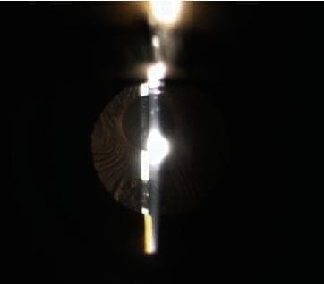 This slit-lamp clinical photograph illustrates a case of anterior capsule contraction syndrome (ACCS), specifically presenting as anterior capsule phimosis. The image captures a highly dense, whitish fibrotic opacity of the anterior lens capsule following cataract surgery. The fibrosis is centrally located and significantly involves the visual axis within the pupillary aperture. The slit beam highlights the irregular thickness and distorted morphology of the fibrotic tissue, which has formed a restrictive ring or membrane over the anterior surface of the intraocular lens (IOL). This condition is a known late complication of phacoemulsification, where metaplasia of residual lens epithelial cells leads to myofibroblast differentiation and capsular shrinkage. The clinical significance of this finding is the severe reduction in visual acuity due to central pupillary obstruction and the potential for IOL decentration or zonular stress if left untreated.