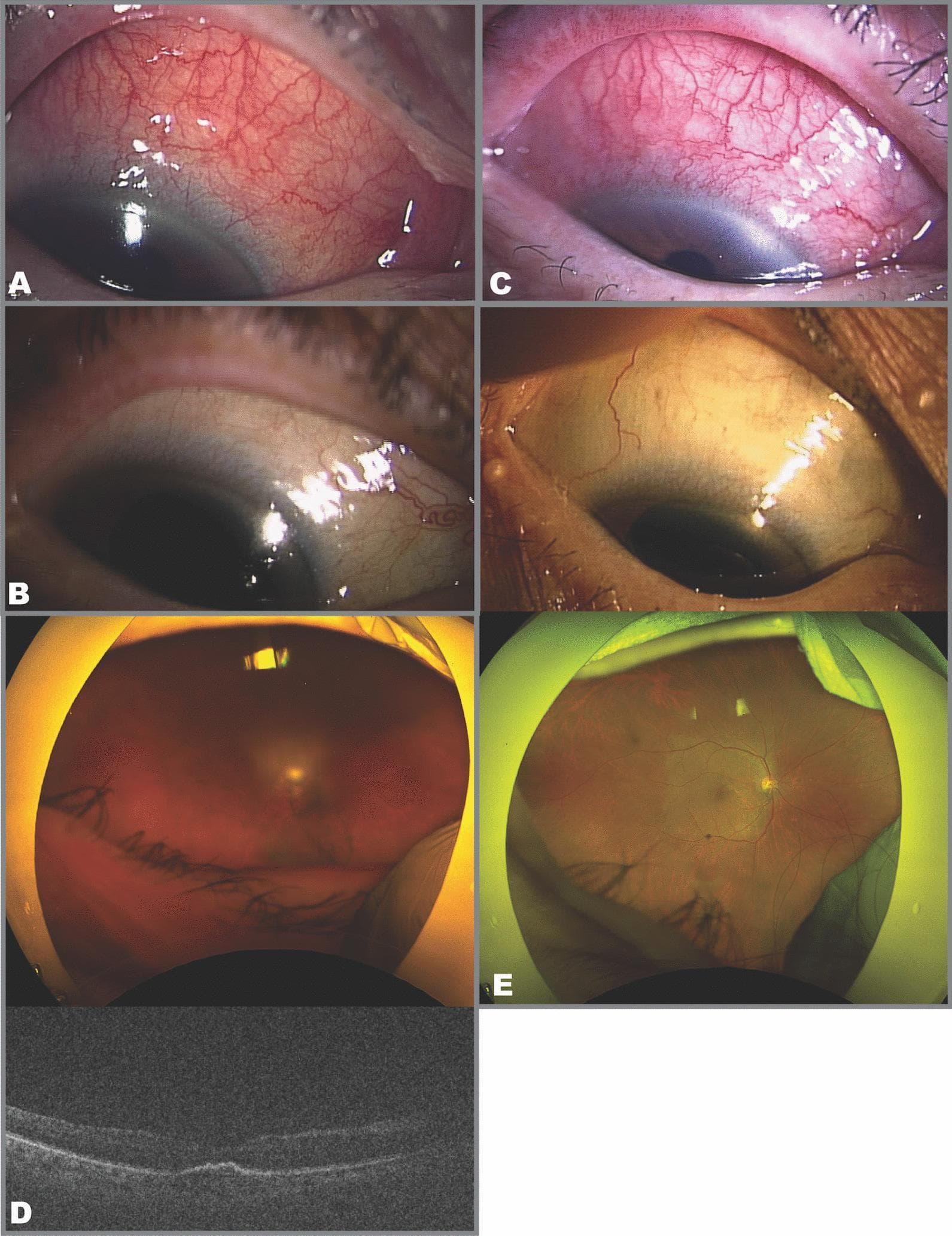 This composite of ophthalmological images documents a clinical case of intraocular inflammation (IOI) following intravitreal brolucizumab injection. Panels A, B, and C are external clinical photographs of the right eye focusing on the superior sclera. Image A shows active, diffuse superior scleritis with intense vascular congestion and episcleral injection. Image B demonstrates clinical resolution of the scleritis following topical therapy, showing a white, quiet sclera. Image C illustrates a recurrence of the scleritis with marked conjunctival and episcleral hyperemia. Panel D includes a wide-field fundus photograph and a corresponding Optical Coherence Tomography (OCT) scan. The fundus image in D shows severe vitreous opacification (haze), obscuring retinal details, while the OCT B-scan displays poor signal-to-noise ratio due to vitreous media opacity, though a macular profile is visible. Panel E shows a follow-up wide-field fundus photograph demonstrating significant clearing of the vitreous opacity, allowing for a detailed view of the optic nerve head, retinal vasculature, and macula. This series illustrates the correlation between clinical scleritis and internal ocular inflammation (vitritis) as complications of intravitreal pharmacotherapy.