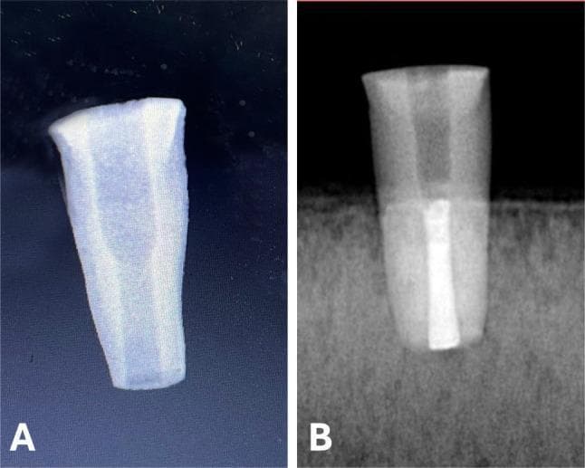 Educational comparison of endodontic root canal procedures on an immature permanent tooth model. Image A displays a diagnostic radiograph of a human tooth root specimen prepared to simulate an immature tooth with an open apex. The specimen shows a standardized 10mm cylindrical structure with an enlarged, radiolucent root canal space and thin dentinal walls. Image B shows the same specimen following orthograde obturation. A highly radiopaque calcium silicate-based filling material is visible within the apical portion of the canal, demonstrating successful apexification or apical plug placement. The filling material exhibits high density compared to the surrounding dentin. This comparison is used in endodontics to illustrate treatment protocols for teeth with incomplete root development, focusing on the visual confirmation of material placement and apical seal quality using radiographic imaging.
