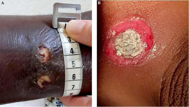 This clinical photograph set displays dermatological manifestations of cutaneous diphtheria (Corynebacterium diphtheriae). Image A shows a close-up of a patient's lower extremity featuring two small, circular ulcerated lesions. The lesions appear well-demarcated with an erythematous, inflammatory border and a central fibrinous exudate. A medical measuring tape is placed alongside the lesions to provide clinical scale, indicating the ulcers are approximately 1 to 1.5 cm in diameter. Image B provides a high-detail view of a characteristic diphtheritic ulcer. This lesion demonstrates a classic 'punched-out' morphology, consisting of a thick, greyish-white necrotic pseudomembrane centrally, which has a slightly textured or leathery appearance. The central necrotic core is surrounded by a prominent, bright red ring of inflamed tissue. These images illustrate the non-specific but clinically significant presentation of cutaneous diphtheria, which often involves multiple inflammatory ulcers that may mimic impetigo or tropical ecthyma, particularly in endemic regions such as French Guiana.