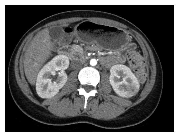 This diagnostic image is an axial slice from a contrast-enhanced computed tomography (CT) scan of the abdomen at the level of the renal hilum. The primary focus is on the bilateral kidneys located on either side of the lumbar spine. The right kidney shows normal parenchymal enhancement. In contrast, the left kidney demonstrates a wedge-shaped, hypoenhancing region localized to the upper pole. This area appears darker (lower attenuation) compared to the surrounding well-perfused renal parenchyma, which is characteristic of reduced blood flow or localized inflammation. The abdominal aorta and major vessels exhibit high density due to the intravascular contrast agent. Other visible structures include the liver, stomach, and bowel loops. Clinically, this focal hypoenhancement in the kidney can be indicative of acute pyelonephritis or a renal infarct. This visual is suitable for medical students and clinicians learning to identify renal pathology through radiological imaging modalities.