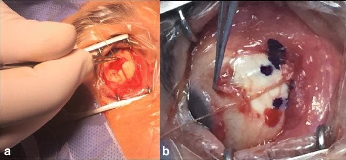 Two side-by-side intraoperative clinical photographs illustrating strabismus surgery using the relaxed muscle positioning technique. Image (a) shows the inferior rectus muscle under manipulation. A wire speculum provides ocular exposure while a surgeon's gloved hand uses forceps to grasp the muscle belly near its insertion. The surgical field exhibits expected conjunctival hyperaemia and minor hemorrhage typical of extraocular muscle dissection. Image (b) shows the medial rectus muscle during a similar procedure. The sclera is visible with dark gentian violet markings indicating the planned recession point for muscle reattachment. A surgical suture is visible traversing the field, and a muscle hook or forceps is used to stabilize the tissue. These images demonstrate the 'relaxed muscle positioning' method where the tendon is released, allowed to retract naturally, and then sutured to the globe at a precise marked point to correct restrictive strabismus or thyroid eye disease-related deviations.