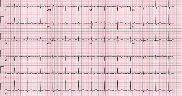 A standard 12-lead electrocardiogram (ECG) displayed on a pink grid background. The tracing represents a normal sinus rhythm. Key visible features include a regular atrial and ventricular rate with a consistent 1:1 P-to-QRS relationship. The P waves are upright in leads I, II, and aVF, and inverted in aVR, indicating a normal sinus axis. The PR interval is within the normal physiological range (approximately 176 ms). QRS complexes exhibit normal morphology and duration without significant axis deviation or pathological Q waves. R-wave progression across precordial leads V1-V6 is appropriate, with the transition occurring between V3 and V4. T waves are upright and symmetrical in the limb and lateral precordial leads. This diagnostic image serves as a baseline comparison for clinical scenarios such as drug-induced bradycardia or cardiovascular monitoring in critical care settings. It illustrates the fundamental components of a healthy cardiac conduction cycle for medical students and clinicians.