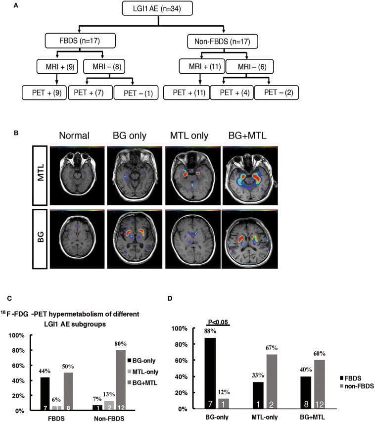 Educational composite figure illustrating neuroimaging patterns in LGI1 autoimmune encephalitis (AE).
Panel A presents a clinical flowchart (n=34) categorizing patients by Faciobrachial Dystonic Seizures (FBDS) status, showing that 18F-FDG-PET has higher sensitivity than MRI, identifying positive findings in most MRI-negative cases.
Panel B displays representative axial brain 18F-FDG-PET/MRI fusion images demonstrating metabolic patterns compared to a normal scan. Hypermetabolism is visualized via heat-map overlays in the Medial Temporal Lobe (MTL only), Basal Ganglia (BG only), or both (BG + MTL).
Panels C and D are bar graphs quantifying these metabolic patterns. Panel C compares the distribution of BG-only, MTL-only, and BG+MTL hypermetabolism between FBDS and non-FBDS groups, highlighting that FBDS patients more frequently exhibit BG-only involvement (44%). Panel D shows the prevalence of FBDS clinical phenotype within each metabolic subgroup, indicating that 88% of patients with BG-only hypermetabolism present with FBDS (P < 0.05). This content illustrates the high diagnostic sensitivity of PET for LGI1 AE and the clinical correlation between basal ganglia hypermetabolism and dystonic seizures.