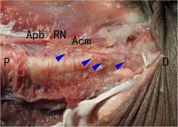 This clinical photograph shows a posterior dissection of a human arm specimen, oriented with proximal (P) and distal (D) labels. The image demonstrates the neurovascular anatomy along the humeral shaft following a Minimally Invasive Plate Osteosynthesis (MIPO) procedure. Key identified structures include the arteria profunda brachii (Apb), the radial nerve (RN), and the arteria collateralis media (Acm). Blue arrowheads highlight several accessory nutrient arteries. These arteries are shown originating from the arteria profunda brachii and entering the mid-distal portion of the humeral shaft posteriorly through the radial groove. The educational focus is the preservation of these critical vascular structures after MIPO, contrasting with potential disruption in more invasive surgical approaches. The image serves as an anatomical reference for orthopedic surgeons and medical students regarding the vascular supply of the humerus and the preservation of biological integrity during fracture fixation.