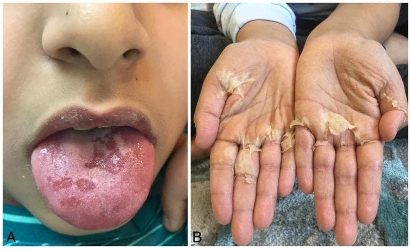 This composite clinical photograph displays two pathognomonic physical findings associated with Kawasaki disease or scarlet fever in a pediatric patient. Panel A is a close-up of the oral cavity showing a 'strawberry tongue,' characterized by an erythematous, beefy-red appearance with prominent, swollen fungiform papillae and patchy white coating. Panel B shows the bilateral palms of the hands exhibiting significant periungual and palmar desquamation. The skin is peeling in large, translucent, sheet-like flakes (lamellar desquamation), particularly concentrated around the distal digits and the central palmar creases, revealing underlying tender, erythematous skin. These findings represent the subacute phase of a systemic vasculitis or toxigenic bacterial infection. The educational focus is on the clinical recognition of mucocutaneous manifestations used in the diagnostic criteria for Kawasaki disease, specifically mucosal changes and extremity desquamation.