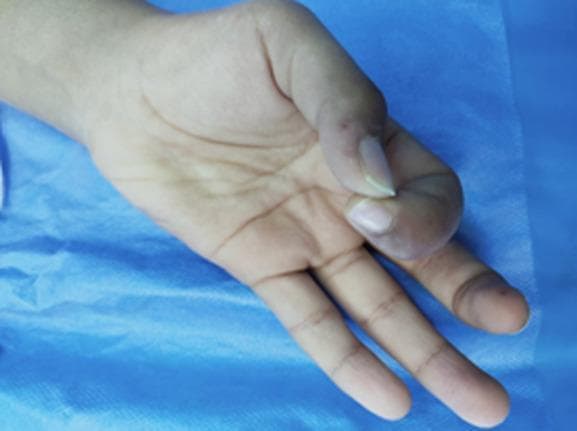 This clinical photograph displays the right hand of a patient, demonstrating a deficit in the digital pollicis pincer grasp. The hand is positioned on a blue sterile drape. Key findings include visible atrophy of the thenar eminence and a characteristic 'ape hand' deformity, where the thumb is adducted and lacks the ability to oppose the other digits effectively. The thumb and index finger are held in a restricted, partially flexed posture with limited range of motion. There is subtle discoloration and swelling noted at the base of the thumb and the distal aspect of the index finger, consistent with chronic median nerve compression. These findings are clinically relevant to Mucopolysaccharidosis (MPS) type 1, which often presents with carpal tunnel syndrome, joint stiffness, and secondary muscular amyotrophy. This image serves as a teaching tool for recognizing the musculoskeletal manifestations of lysosomal storage diseases and secondary median nerve dysfunction.