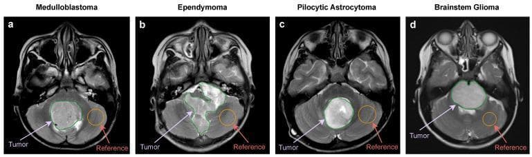 This diagnostic image set consists of four axial T2-weighted (T2W) MRI scans illustrating different types of pediatric posterior fossa tumors. Each panel includes a manually delineated tumor region of interest (ROI) in green and a normal-appearing parenchyma reference ROI in orange. Panel (a) shows a Medulloblastoma in an 8-year-old boy, characterized by a well-defined circular ROI with predominantly intermediate signal intensity. Panel (b) depicts an Ependymoma in a 3-year-old boy, showing a more irregular, heterogeneous ROI with mixed high and intermediate signal intensities. Panel (c) displays a Pilocytic Astrocytoma in a 7-year-old girl, featuring a well-defined round ROI with high signal intensity (hyperintensity). Panel (d) illustrates a Brainstem Glioma in a 6-year-old girl, presenting a homogeneous high signal intensity within the delineated brainstem region. The comparison highlights differences in tumor morphology, signal intensity, and anatomical location (cerebellar midline vs. brainstem vs. fourth ventricle) used for radiological classification and machine learning training.