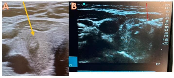 This dual-panel diagnostic image displays high-resolution ultrasound views of the thyroid gland, illustrating the procedure for ultrasound-guided Fine-Needle Aspiration Cytology (FNAC). Panel A shows a transverse ultrasound view of the right thyroid lobe containing a suspicious nodule marked with a yellow arrow. The nodule is roughly circular with heterogeneous echogenicity and irregular internal margins, categorized clinically as TI-RADS 4, indicating a moderate suspicion of malignancy. Panel B demonstrates the procedural phase, where a 21-gauge biopsy needle (red arrow) is visualized as a linear hyperechoic structure. The needle is shown utilizing a trans-isthmic approach at a shallow angle to accurately target the center of the hypoechoic nodule. These images serve as an educational resource for interventional endocrinology and radiology, highlighting the importance of real-time needle visualization during biopsy to ensure diagnostic accuracy and safety in managing potentially malignant thyroid lesions.