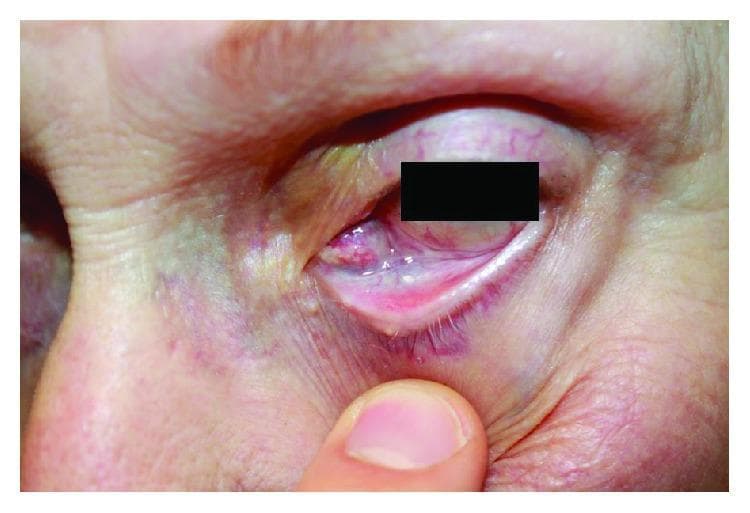 Clinical photograph of the left eye of an elderly patient demonstrating a significant medial orbital mass and secondary ocular changes. The image shows a prominent, fleshy, erythematous mass located at the medial canthus, which is causing significant mechanical ectropion (outward turning) of the lower eyelid. The affected lower eyelid appears inflamed, with visible conjunctival hyperaemia and swelling. Evidence of symptomatic epiphora is present, characterized by a glistening, wet appearance of the periocular skin and clumping of the lower eyelashes. The skin around the inner corner of the eye exhibits erythema and mild maceration, likely due to chronic tear exposure. This clinical presentation is characteristic of a rapidly growing orbital tumor, later diagnosed as epithelioid sarcoma, which physically displaces local adnexal structures and obstructs the lacrimal drainage system. The image serves as a high-level educational example of orbital pathology, the clinical signs of mechanical eyelid malposition, and the physical manifestations of lacrimal outflow obstruction.