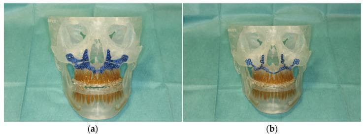 Clinical photograph of a 3D-manufactured patient skull model utilized for surgical planning in oral and maxillofacial surgery. The image shows two views of a transparent anatomical model of a human skull, specifically focusing on the mid-face and mandible with integrated dental arches. Frame (a) demonstrates a patient-specific cutting guide (PSCG) rendered in blue, positioned along the anterior maxilla to facilitate a precise Le Fort I osteotomy. Frame (b) illustrates a patient-specific implant (PSI), also in blue, which is designed for fixation and stabilization following the osteotomy. The model includes detailed brown-colored dentition for accurate occlusal referencing. This surgical simulation tool is used to validate the fit of CAD/CAM components, such as selective laser melted (SLM) hardware, and to coordinate robot-guided laser surgery for correcting skeletal malocclusions. The visualization emphasizes the integration of digital surgical planning with physical anatomical replicas for pre-operative rehearsal and intra-operative guidance.