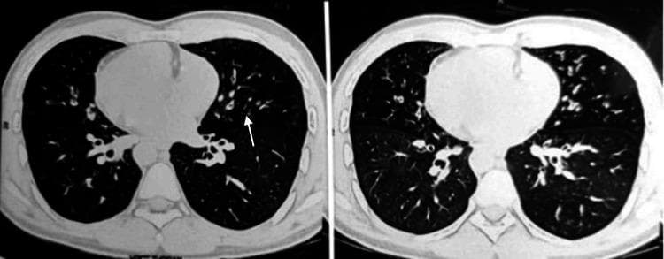 High-resolution computed tomography (HRCT) of the chest in axial view demonstrating findings consistent with bronchiectasis and bronchiolitis. The diagnostic image shows bilateral pulmonary abnormalities, including prominent peribronchial wall thickening and bronchial dilatation. Key radiological signs include the 'signet ring' sign (dilated bronchus larger than its accompanying pulmonary artery) and 'tram-track' opacities (parallel thickened bronchial walls). Small, centrilobular nodular opacities are visible in a 'tree-in-bud' pattern, particularly in the mid and lower lung zones, suggesting small airway impaction or infectious bronchiolitis. Additionally, the images reveal dextrocardia, with the cardiac apex and heart shadow oriented toward the right hemithorax, indicative of situs inversus. This combination of bronchiectasis, sinusitis (contextual), and situs inversus totalis is highly suggestive of Kartagener syndrome. The content is suitable for medical education regarding congenital ciliary dyskinesia and chronic inflammatory lung disease.