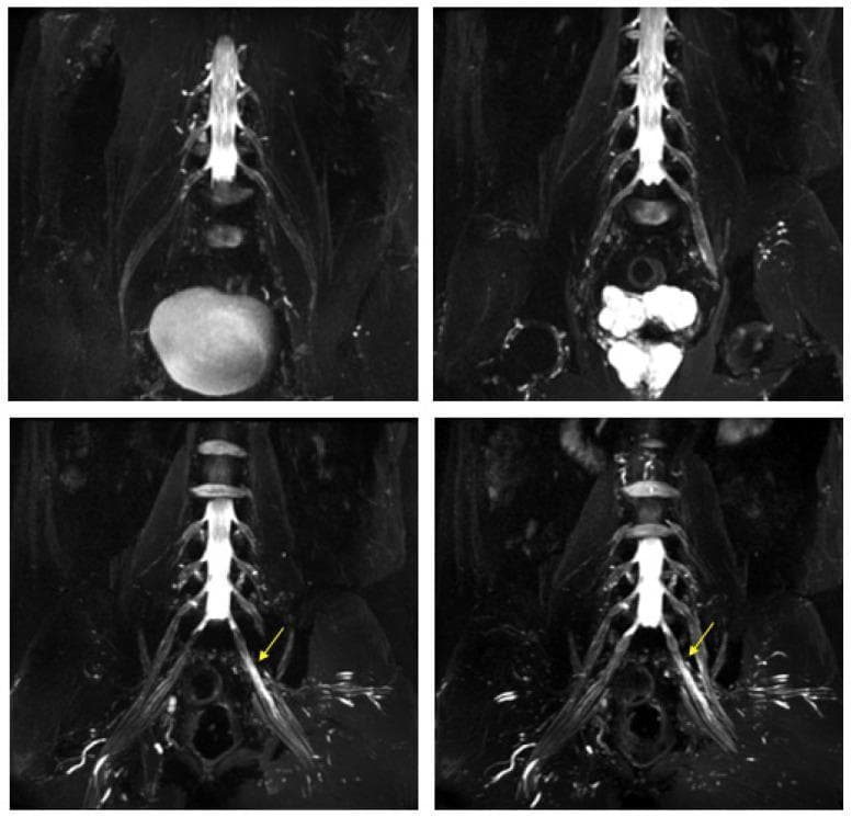 Diagnostic Image: This composite shows four Maximum Intensity Projection (MIP) reconstructions of a 3D-cube T2-weighted (T2W) MR neurography sequence focusing on the lumbosacral plexus. The images reveal a diffuse, moderate increase in the thickness and signal intensity of the lumbar and sacral nerve roots bilaterally. Specifically, in the lower panels, yellow arrows highlight the left S1 nerve root, which demonstrates asymmetric pathological thickening and marked T2 hyperintensity compared to the contralateral side. The anatomical landmarks include the lower lumbar vertebrae, sacrum, and the exiting nerve roots that form the sciatic nerve. These findings are characteristic of hypertrophic neuropathy or inflammatory polyradiculopathy, illustrating key diagnostic features such as nerve root enlargement (hypertrophy) and edema-like signal changes (hyperintensity) on fluid-sensitive MRI sequences. The medical specialty is Neuroradiology, intended for intermediate to advanced learners studying peripheral nerve imaging and plexopathy.