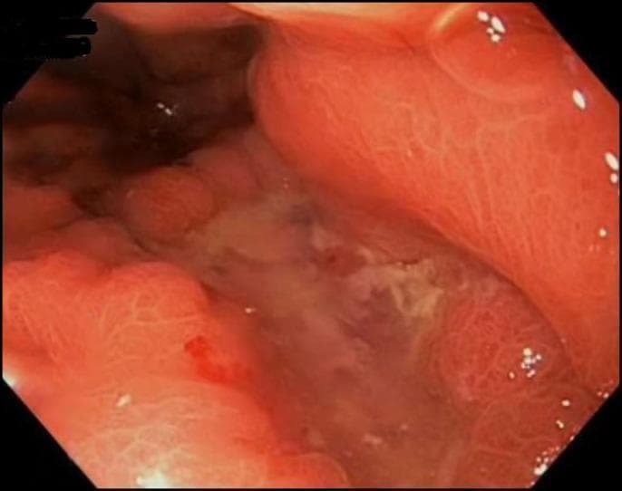 This endoscopic clinical photograph displays a large, cratered gastric ulcer located on the lesser curvature of the stomach. The lesion measures approximately 10 mm at its widest dimension and is characterized by a depressed, slough-covered base with whitish fibrinopurulent exudate. The ulcer edges are well-demarcated but notably irregular, with surrounding gastric mucosa appearing erythematous and nodular, suggesting significant localized inflammation and edema. No active spurting, oozing, or visible vessels (stigmata of recent hemorrhage) are observed within the ulcer bed, though minor punctate hemorrhage is visible on the peripheral margin. The surrounding vascular pattern of the gastric wall shows hyperemic changes consistent with underlying pathology, which in this clinical context was confirmed as adenocarcinoma with hepatoid features. This image serves as a teaching example for evaluating ulcer morphology and identifying the absence of high-risk bleeding stigmata during diagnostic upper gastrointestinal endoscopy.