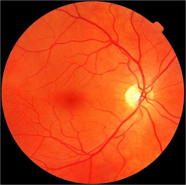 This clinical diagnostic image is a color fundus photograph of the human retina, specifically demonstrating mild non-proliferative diabetic retinopathy (NPDR). The image captures the posterior pole, showing the optic disc as a well-defined, yellowish-white circular structure located on the nasal side (right side of the frame). From the optic disc, retinal arteries and veins emerge and branch across the orange-hued retinal background toward the periphery. Centrally and slightly temporal to the disc, the macula is visible as a darker, less vascularized region. Pathological features characteristic of early-stage diabetic retinopathy are present, including isolated microaneurysms that appear as small, discrete red dots. There is also a subtle focal red lesion in the temporal region, which may represent a small blot hemorrhage. The overall vascular architecture remains relatively preserved without significant neovascularization, hard exudates, or cotton wool spots, aligning with a 'mild' classification on the Diabetic Retinopathy Disease Severity Scale. This image serves as an educational example for identifying early microvascular changes in diabetic patients during routine screening.