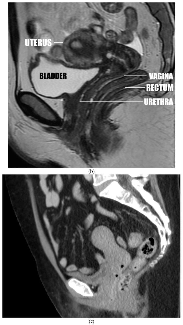 This composite educational graphic features diagnostic images in the sagittal plane demonstrating various uterine positions and pelvic floor anatomy. Image (b) is a T2-weighted sagittal MRI of the female pelvis showing an anteverted uterus. Key anatomical structures are labeled, illustrating the uterus positioned superior to the bladder, with the vagina situated inferior to the uterus and posterior to the bladder. The rectum is shown posterior to the vagina, while the urethra is visible anterior and slightly inferior to the vaginal canal. Image (c) is a sagittal CT reconstruction depicting an anteverted uterus that is separated from the bladder. The series serves as an educational tool for identifying uterine version and insertion types (anterior, apical, or posterior) and understanding their spatial relationships with adjacent pelvic organs. The imaging highlights the clinical significance of uterine orientation in relation to pelvic floor support and conditions such as uterine prolapse.