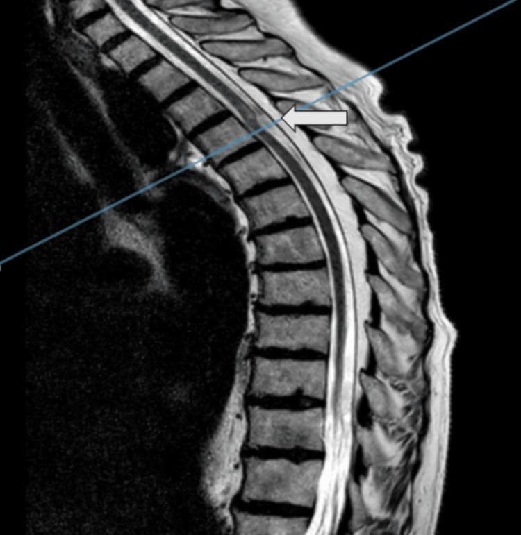 This diagnostic image is a T2-weighted sagittal MRI of the thoracic spine, highlighting the anatomical region between the upper thoracic and lumbar vertebrae. A white arrow points to an intraspinal, intradural mass located at the T4 vertebral level. The lesion exhibits altered signal intensity compared to the surrounding spinal cord tissue, characterized by a slightly hyperintense appearance. Morphologically, the mass is elongated and irregular, causing focal compression or displacement of the cord. The superior aspect of the spinal cord adjacent to the lesion shows signs of myelopathic changes, evidenced by intramedullary signal hyperintensity. The surrounding vertebral bodies and intervertebral discs maintain normal vertical alignment and signal characteristics for this imaging modality. Clinically, this imaging illustrates a rare spinal pathology, such as a spinal arachnoid web, emphasizing the diagnostic importance of MRI in evaluating myelopathy and intradural extramedullary lesions in the thoracic spine for neurosurgical planning.