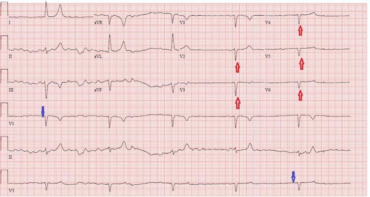 A 12-lead electrocardiogram (ECG) demonstrating a junctional rhythm characterized by a significant bradycardia (heart rate approximately 32 bpm) and the absence of discernible P-waves, as indicated by blue arrows in leads III and V5. The QRS complexes are relatively narrow, typical of a junctional origin. Notable precordial findings include poor R-wave progression (PRWP), highlighted by red arrows in leads V2 through V6, where the expected incremental increase in R-wave amplitude from the right to left precordial leads is absent. T-waves in several leads appear peaked or tall, which, in the clinical context of the patient's severe hyperkalemia (8.3 mEq/L) and acute kidney injury, suggests electrolyte-induced cardiac conduction abnormalities. This ECG provides a classic educational example of metabolic derangements affecting cardiac rhythm and conduction, specifically illustrating a junctional escape rhythm common in severe hyperkalemic states.