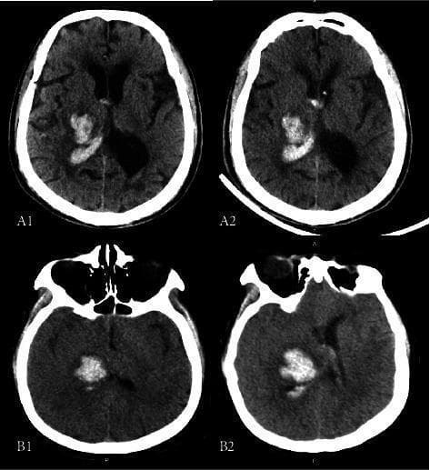 This clinical diagnostic image consists of four axial non-contrast CT scans of the brain, comparing baseline and follow-up imaging for two patients with intracerebral hemorrhage (ICH). Scans A1 and A2 (Patient A) show a hyperdense right thalamic hematoma with clear involvement of the posterior limb of the internal capsule (PLIC). The baseline (A1) and follow-up (A2) demonstrate stable hematoma volume without significant expansion. Scans B1 and B2 (Patient B) illustrate hematoma expansion (HE) over time. The baseline scan (B1) reveals a hyperdense acute hemorrhage in the right thalamus; the follow-up scan (B2) shows a visible increase in the size and volume of the hematoma, which exerts mass effect on the adjacent ventricular system and deep white matter tracts. These images are used to illustrate the radiological assessment of thalamic stroke, the anatomical relationship between the thalamus and the internal capsule, and the clinical phenomenon of hematoma expansion in acute hemorrhagic stroke management.